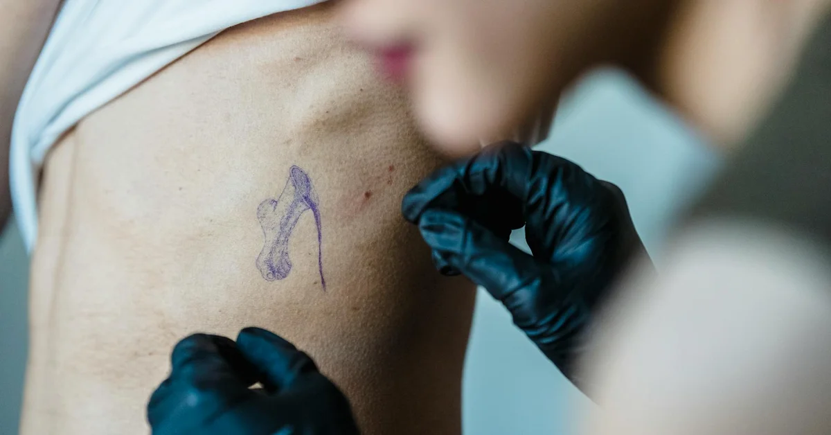 Close-up of a clinician wearing gloves tending to a small minimalist tattoo on a client's upper arm, prepping for laser removal.