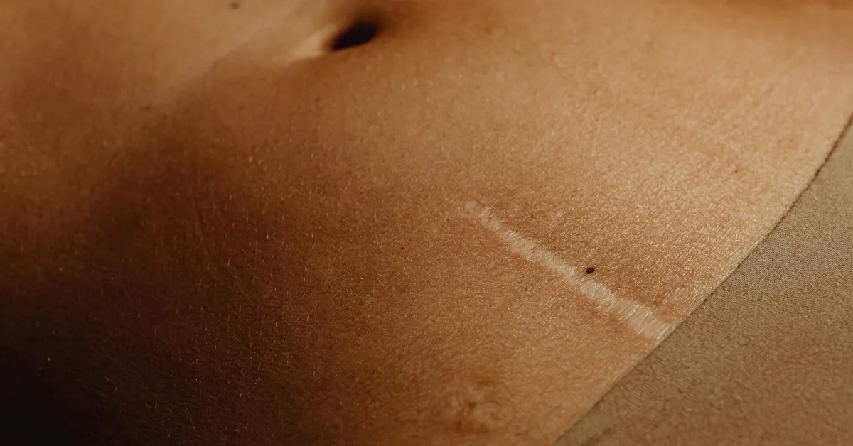 Can You Use Exfoliants on a Removed Tattoo? A Tattoo Artist’s Guide