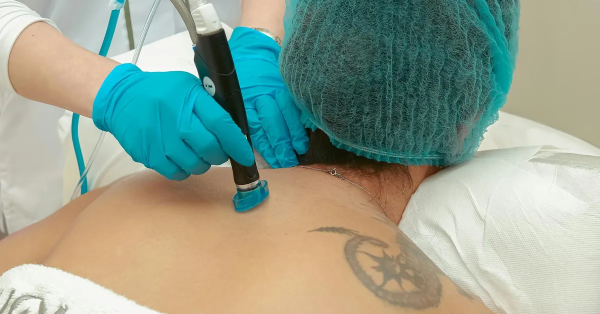 Clinician in blue gloves uses a laser device on a tattoo on a patient's upper back, in a clinical setting.
