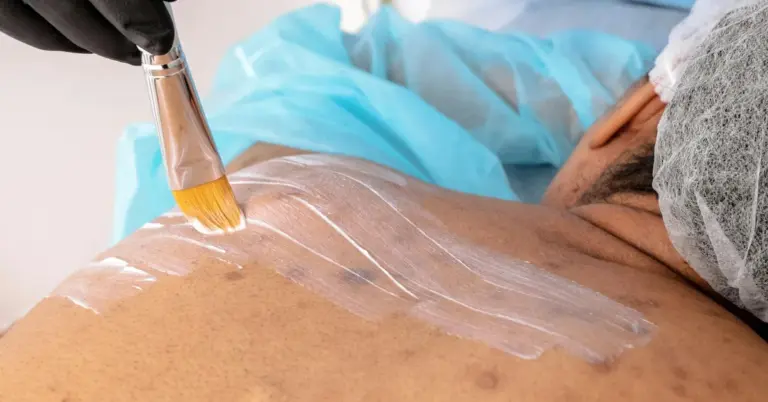 Clinician wearing gloves applies white ointment with a brush to healing skin on a patient's upper back after tattoo removal.