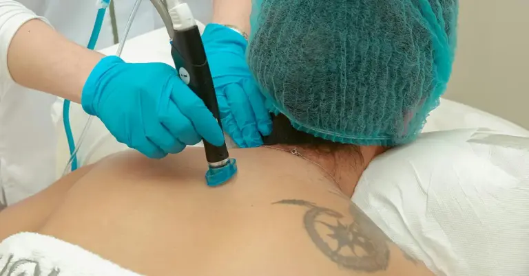 Medical professional in turquoise gloves uses a laser device on a tattoo on a patient’s upper back.